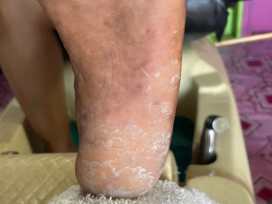 Gel pedicure with callus removal